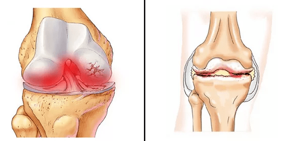 Comparación de artrose de artrite