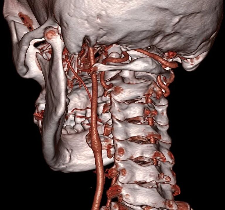 arteria pinchada con osteocondrose cervical