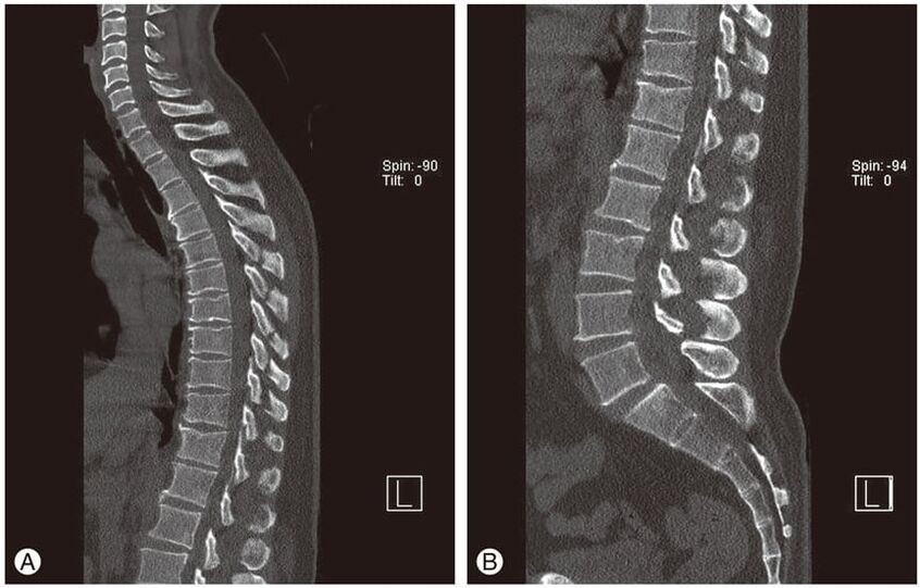Deformación de discos intervertebrais en imaxes de resonancia magnética na osteocondrose torácica