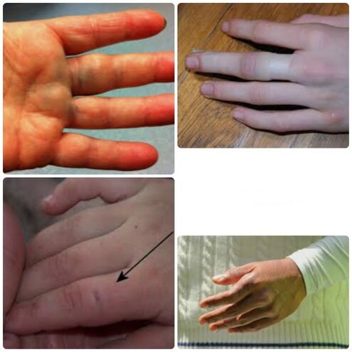 Os hematomas e as fracturas dos dedos caracterízanse por dor e inchazo nas articulacións