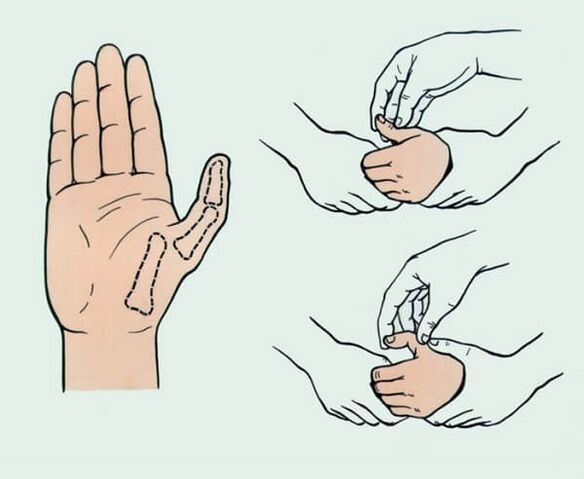 Redución dun dedo luxado, necesario para eliminar a dor articular