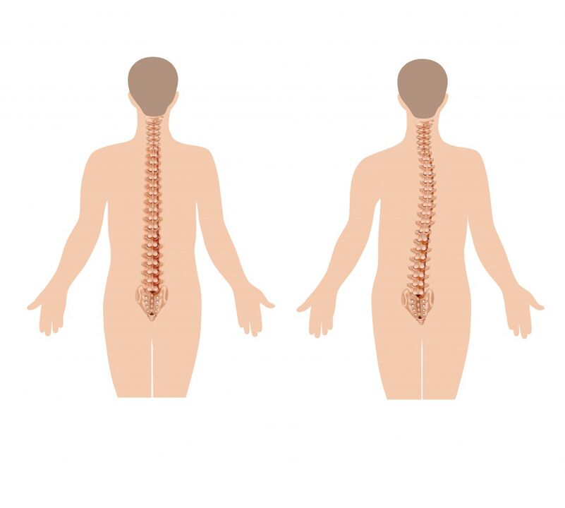 columna vertebral sana e enferma