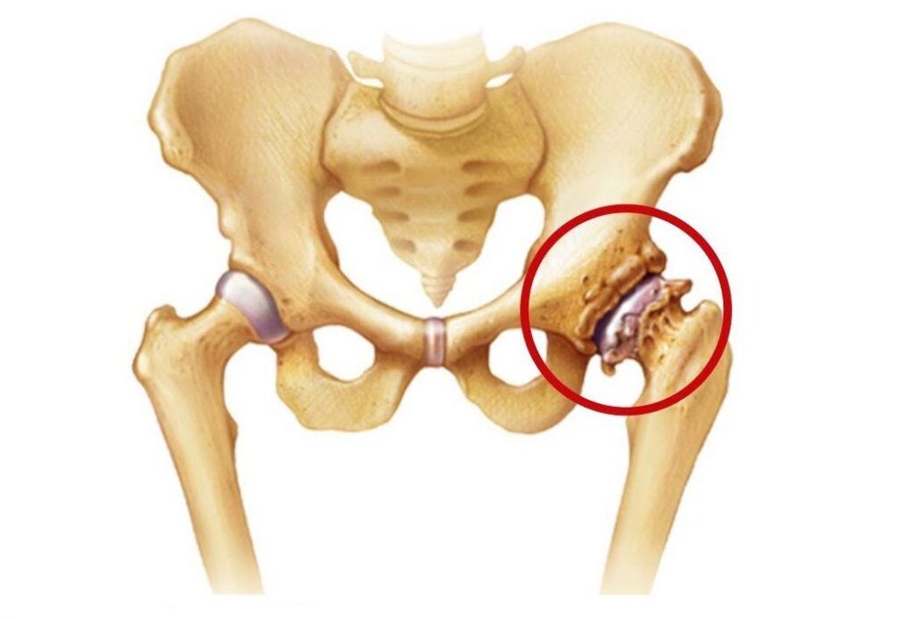 Articulación da cadeira afectada por artrose