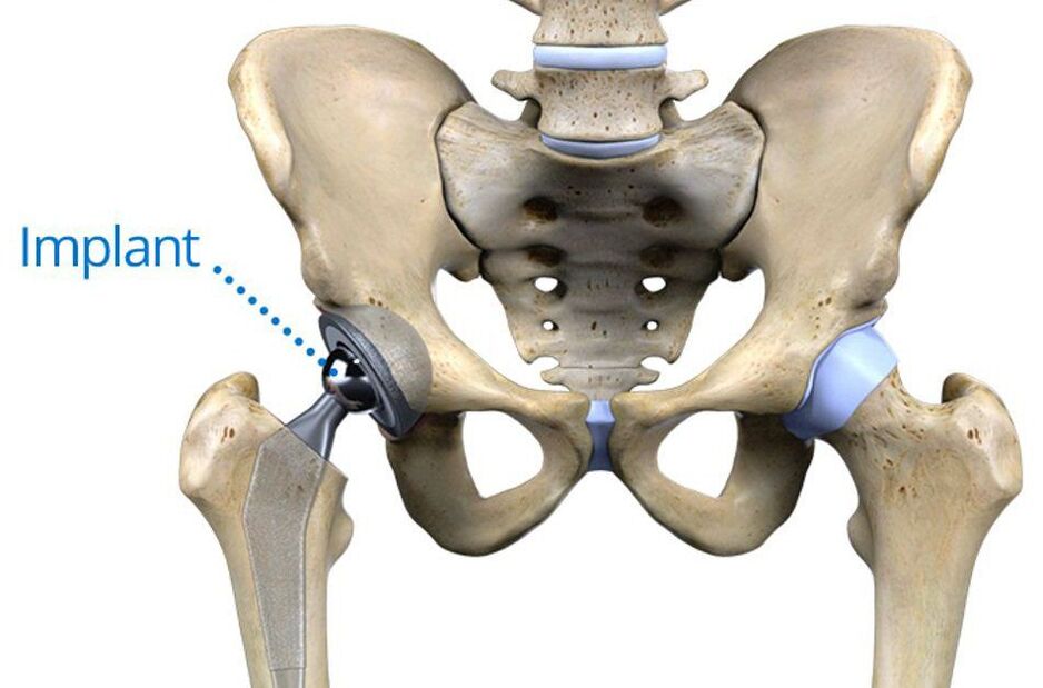 Artroplastia total de cadeira para artrose