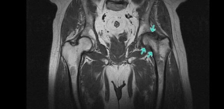 Osteoartrite da articulación da cadeira na resonancia magnética