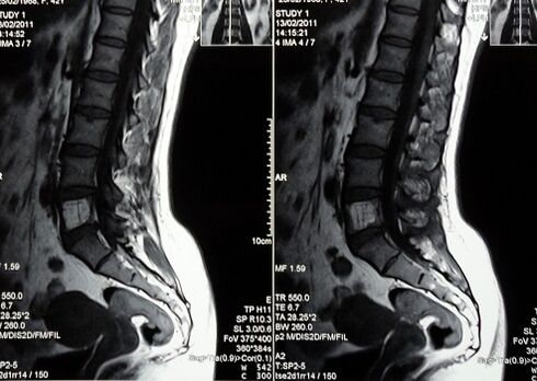 Resonancia magnética da columna lumbosacra para diagnosticar dor lumbar